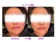 ディアレスト(Dearest)/ハイフ(顔)3層アプローチ