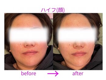 ディアレスト(Dearest)/ハイフ(顔)3層アプローチ