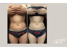 ビューティーサロン アール(R)/痩身マシーンお腹