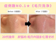 ウル 下北沢(Ulu)/韓国式３D毛穴洗浄