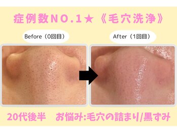 ウル 下北沢(Ulu)/韓国式３D毛穴洗浄