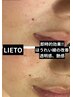 最先端美容【ゴールが見えるケア】エステダーマ.ペン¥12,000→¥9,800☆