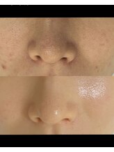 セラ(SERA)/セラピール