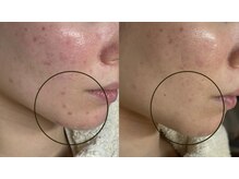 リリーラボ(LILY LAB)/顎ニキビ改善得意です◎