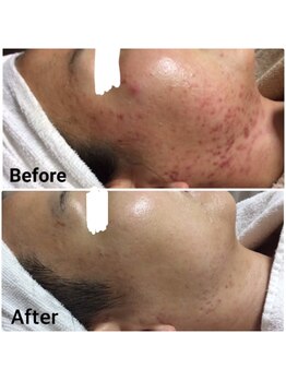 ビズビズ 天王寺店(bisebise)/ニキビ/毛穴開き黒ずみ角栓詰り