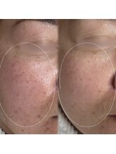 アトリーチェ ベレッツァ(ATTRICE Bellezza)/リアボーテスペシャルケア