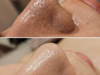 ボウ 静岡本店(VOEUX)の写真/大人ニキビと一緒に気になる毛穴・ざらつきに。肌状態に合わせたフェイシャルケア