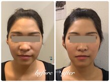 パルティール(PARTIR)/小顔マシン利用♪