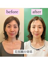 ゲンキ鍼灸整骨院 丸太町(Genki鍼灸整骨院)/美容鍼の効果