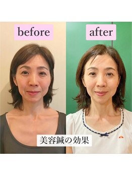 ゲンキ鍼灸整骨院 丸太町(Genki鍼灸整骨院)/美容鍼の効果