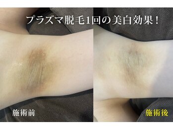 アネル 豊見城(anel)/ワキの黒ずみ改善◎プラズマ脱毛