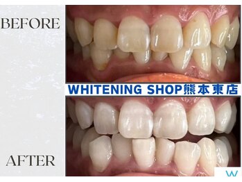 ホワイトニングショップ熊本東店/ホワイトニングショップ熊本東店