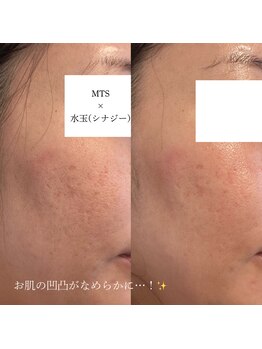 ひっそり美肌構築/MTS×水玉(リジュラン導入)