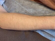 ヨハク(YOHAKU)/20代前半　男性　6回施術before