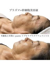パシト(pasito)/ニキビ年齢肌プラズマ×幹細胞◎