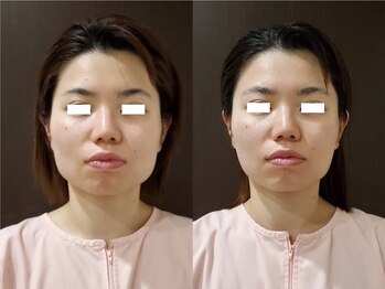セラピアの写真/コルギで叶える理想の小顔へ！リフトアップで左右差もケア◎小顔矯正で自信あふれるフェイスラインを☆