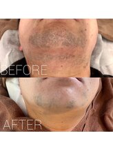 バーニー 梅田店(BARNEY)/ヒゲ脱毛　経過/脱毛/顔脱毛