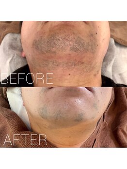 バーニー 梅田店(BARNEY)/ヒゲ脱毛　経過/脱毛/顔脱毛