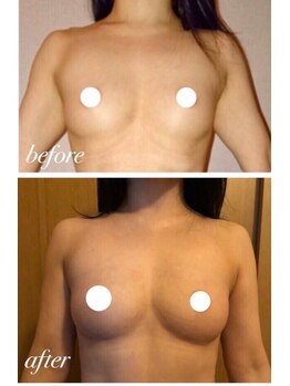 ソラ(sora)/バストアップ・バストケア症例★