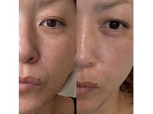 コチ(kocsi)の雰囲気（左側は当初、右側は３回目のエステ。論より証拠。）