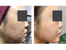 カノン(Kanon.)/リベルハーブピーリング