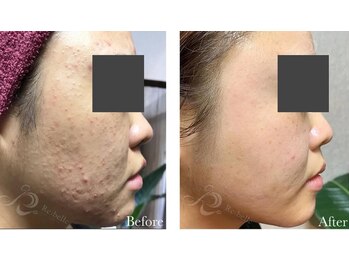 カノン(Kanon.)/リベルハーブピーリング