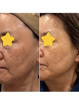 ロッカ(ROCCA..)/シミも?!