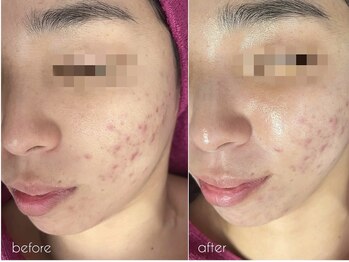 バタフライ 津田沼店(Butterfly)/Butterflyのハーブピーリング