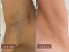 【女性全員】ワキ脱毛★気になる自己処理をラクに♪￥3000