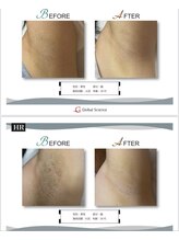 サンバイエム(#3/M)/ワキ脱毛