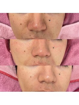 モファ(mofa)/ハーブピーリング施術例♪