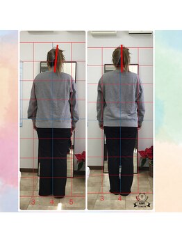 カイロプラクティック コダマ(KODAMA)/姿勢矯正ビフォーアフター