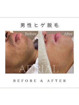 エアリアル 武雄店/まずはヒゲ脱毛から!