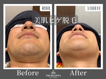 メンズスタジオ リボーン(REBORN)/顔脱毛/ひげ脱毛/松山