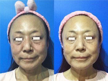 ソイズ 上中居店(SOIS)/小顔コルギ