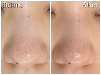 ホワイトアクア 四日市店(WHITE AQUA)/ララピール/毛穴ケア/シミ改善