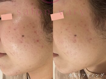 サロンヴェアリー 広尾(salon vary)/#ニキビケア#敏感肌