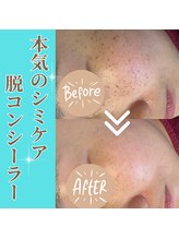 クリニカルココ 香椎店(クリニカルCOCO)/シミケア