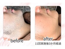 イチキュービー 仙台駅前東口店(19B)/男性のひげ脱毛の経過