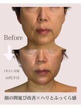 アンジェリカ(Angelica)/ほしいのはハリ！ふっくら中顔面