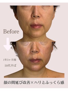 アンジェリカ(Angelica)/ほしいのはハリ！ふっくら中顔面