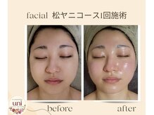 パーソナル ユニ(uni)/松ヤニスタンダード1回施術