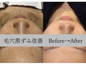 ラリマ グラマラス(Larima Glamorous)/1回目はお掃除、2回目からが本番