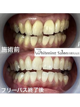 ホワイトニングサロン 京都烏丸店/ホワイトニンぐ施術例