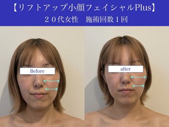 リプロ(RePro)/30代 ビフォーアフター