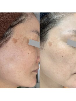 エステサロンブランシュ(Esthe salon Blanche)/ハーブピーリング＋ホームケア