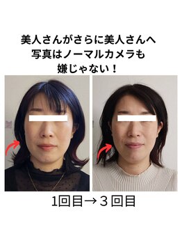 ニコ(Nico)/before・after　小顔矯正