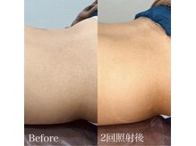 ハイリー(Hily)/腰周り before、after