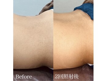 ハイリー(Hily)/メンズ脱毛 before、after