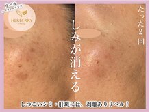 アッシュ 梅田(H)/ハーブピーリング専門Hアッシュ